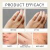 Ximonth Mole And Wart Care Cream, Soft And Smooth Skin Moisturizing And ing Skin Care Cream